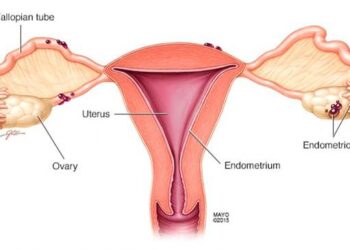 LẠC NỘI MẠC TỬ CUNG LÀ GÌ? CÁCH CHẨN ĐOÁN VÀ XÉT NGHIỆM CẦN THIẾT