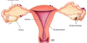 LẠC NỘI MẠC TỬ CUNG LÀ GÌ? CÁCH CHẨN ĐOÁN VÀ XÉT NGHIỆM CẦN THIẾT